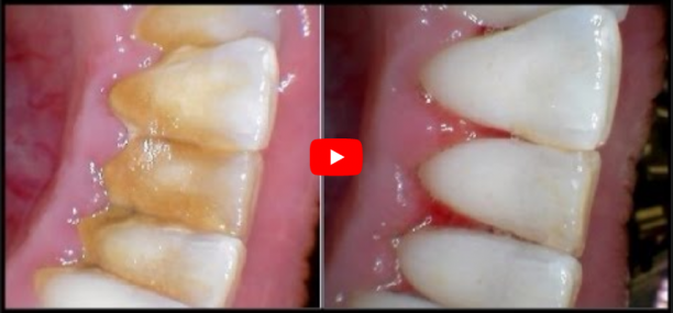 how to remove tartar from teeth without going to the dentist