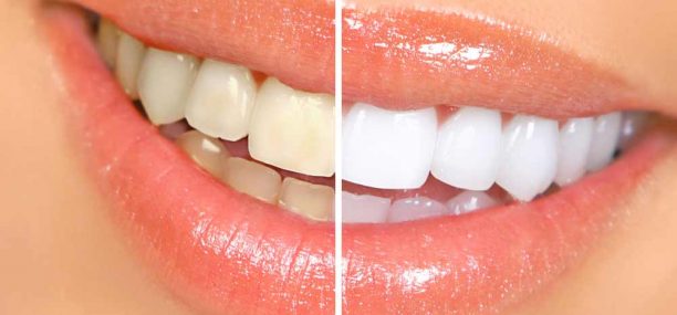 How to whiten teeth naturally at home fast
