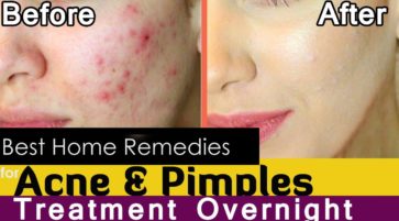 How to cure acne and pimples on face overnight