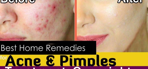 How to cure acne and pimples on face overnight