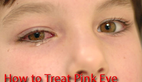 How to cure pink eye at home fast