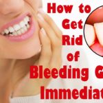 How to stop your gums from bleeding naturally at home