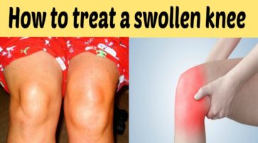 How to treat a swollen knee at home naturally
