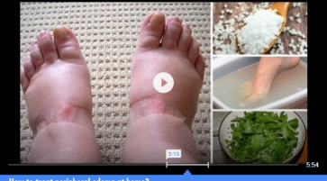 How to treat peripheral edema at home