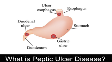 What is Peptic Ulcer Disease? Causes Symptoms and Treatment