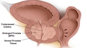 What is Benign Prostatic Hyperplasia BPH