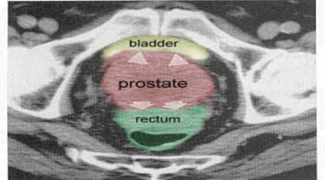 What is Follicular Prostatitis? Causes Symptoms and Treatment