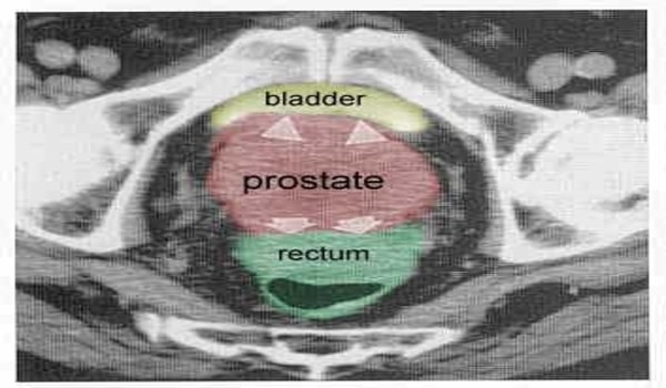 What is Follicular Prostatitis? Causes Symptoms and Treatment